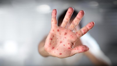 Kasus Campak Melonjak di Amerika Serikat